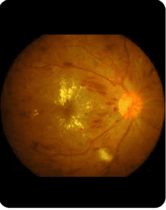 Diabetic Retinopathy