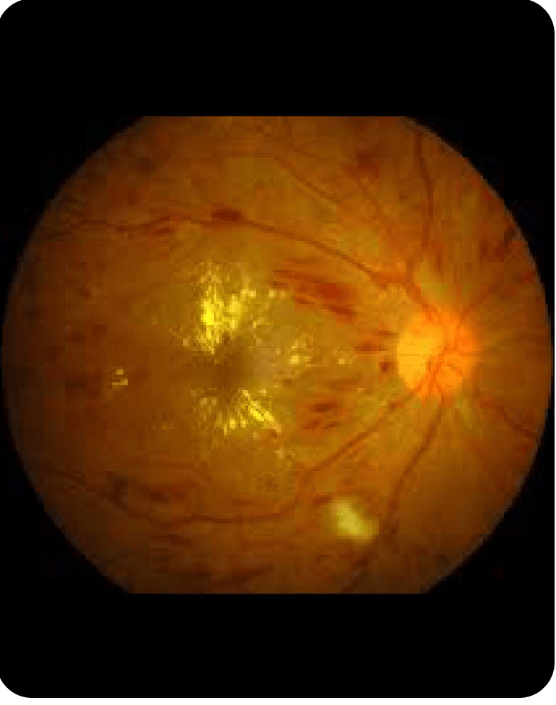 Diabetic Retinopathy