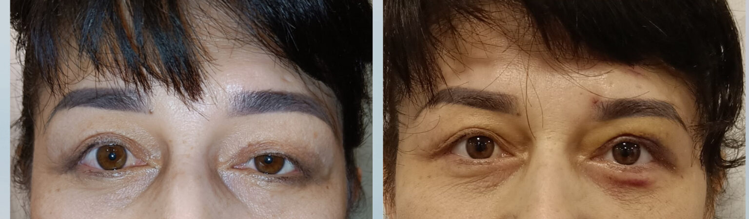 Ptosis surgery