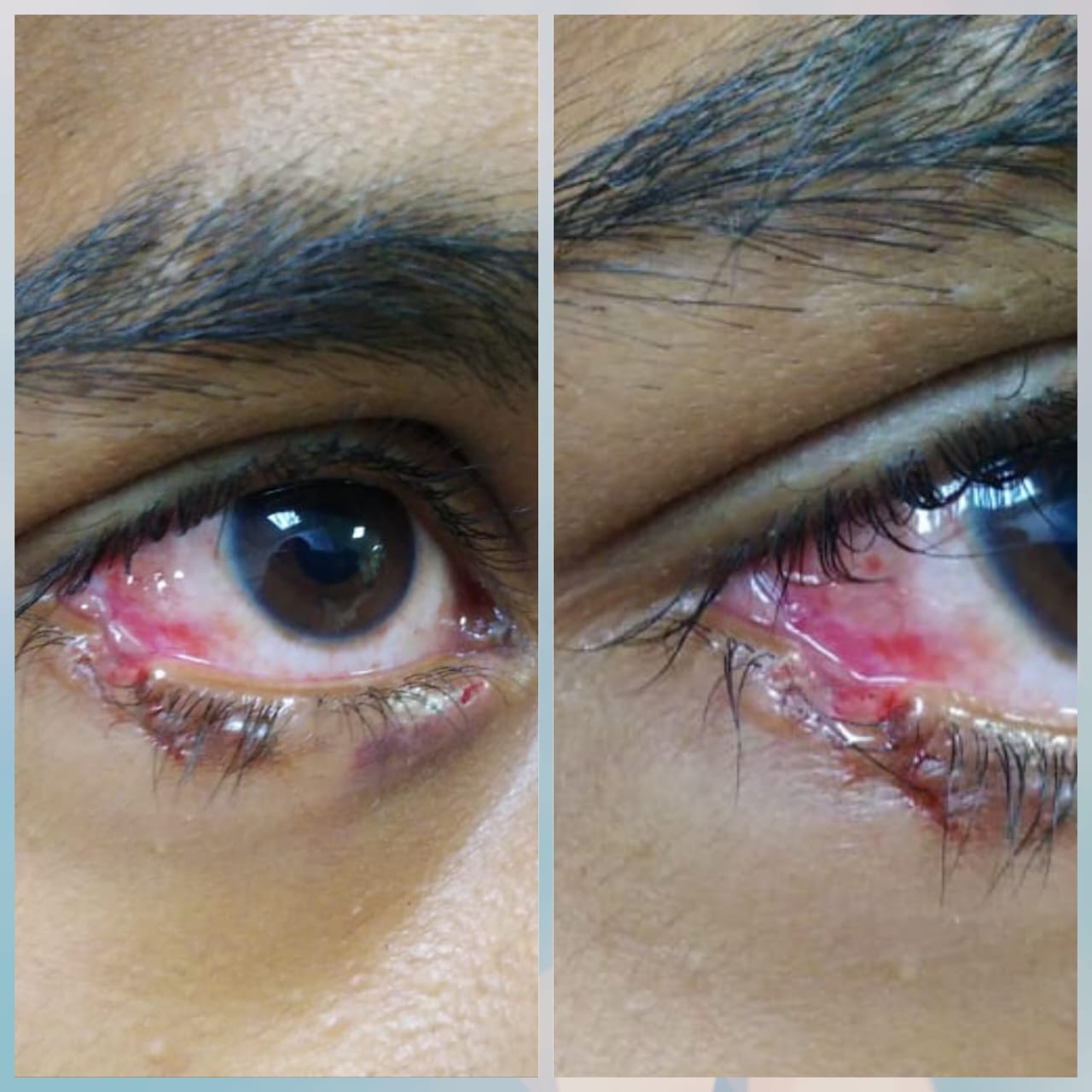 EyeLid Trauma: Restoring Sight and Confidence with Reconstructive ...