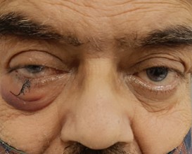 Eyelid repair after injury