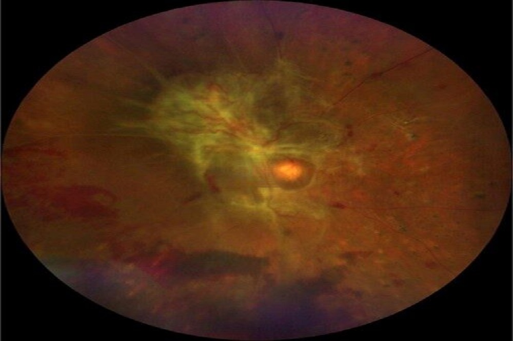 Diabetic Retinopathy