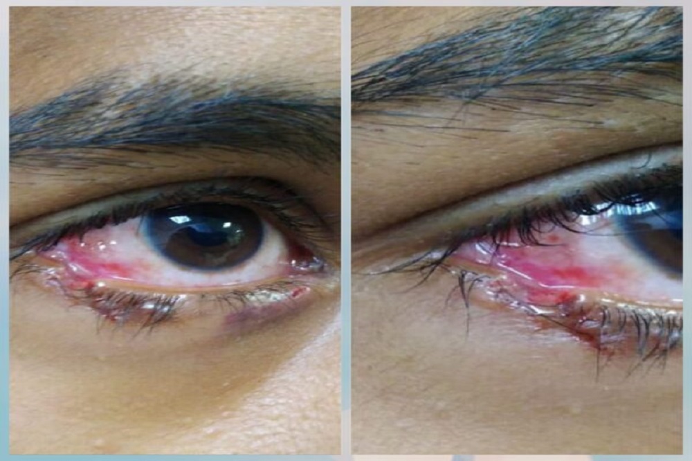 Eyelid laceration repair