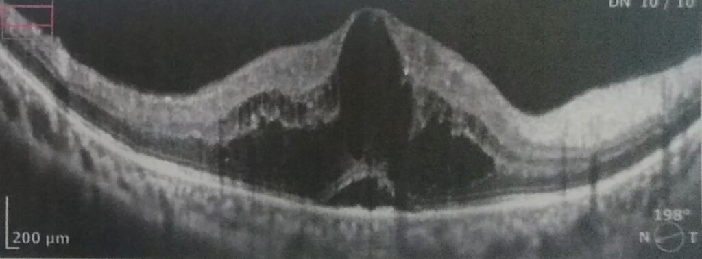 OCT - Diabetic Retinopathy