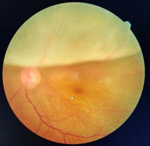 Retinal detachment treatment